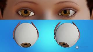 How is strabismus surgery done [upl. by Aretha]