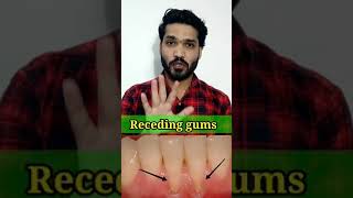 नीचे जा रहे मसूड़ो का घरेलू इलाज  Gum recession home remedies  easy dentistry shorts [upl. by Nivat]