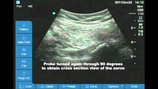 Posterior approach to sciatic nerve [upl. by Ramos]