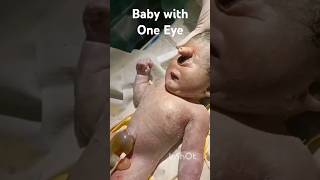 Baby with One Eye shorts health [upl. by Waylan]