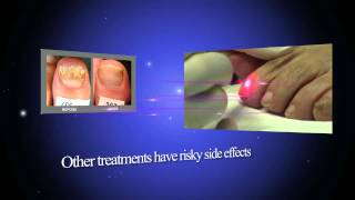 Get rid of toenail fungus with tthe Pinpointe Laser [upl. by Stephan224]