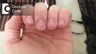 What causes white spots on nails and how to manage them  Dr Amee Daxini [upl. by Aneeh]