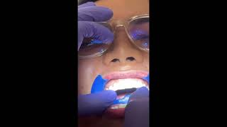 Make your smile beautiful  20 units ceramage veneers dentalcare highlights everyone [upl. by Kolosick]