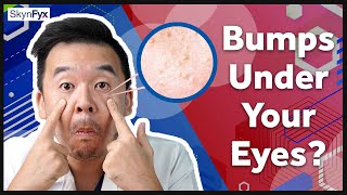 Milia Syringoma Skin Tag amp F Spots Explained [upl. by Eerhs]