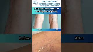 Varicose Veins in surgery and Seeking Solutions varicoseveins telugu hospital symptoms [upl. by Thibaud]