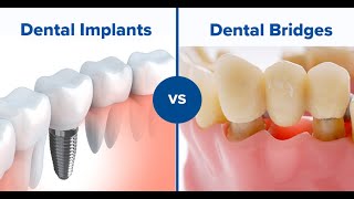 Which is better a dental bridge or implant [upl. by Hplodnar]