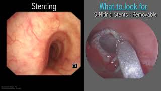 Mastering Bronchoscopy for Thoracic Surgery Chapter 3 [upl. by Anairuy]