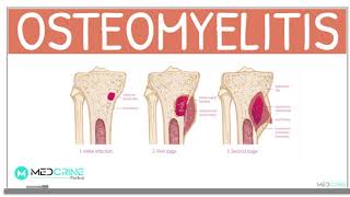 Osteomyelitis Classification Causes Pathophysiology Signs and Symptoms Diagnosis and Treatment [upl. by Tamarah]