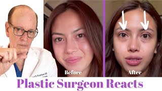 Getting Eyelid Surgery Blepharoplasty  Plastic Surgeon Reacts [upl. by Akirej]