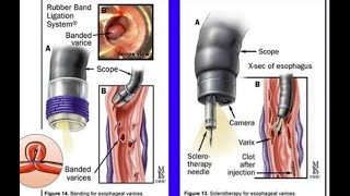 Skleroterapia ne endoskopi perdorët ne [upl. by Felicia63]