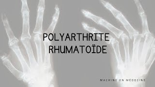 Polyarthrite Rhumatoïde PR [upl. by Sebastien]