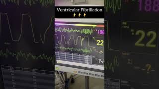 Ventricular fibrillationventricular fibrillationmedicaleducation medicalcollegestudents [upl. by Carlotta219]