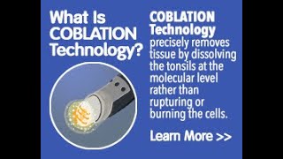 Coblation assisted adenoidectomy [upl. by Ewnihc]