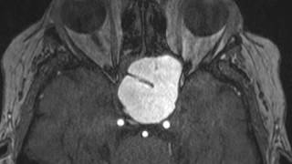 Sphenoid Mucocele [upl. by Doownelg]