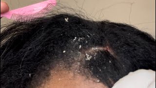 Scratching Scabs off Itchy Scalp  Picking Dandruff Flakes  Psoriasis [upl. by Enelkcaj300]