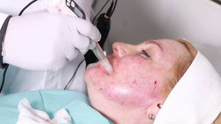 Mesotherapy and dermapen microneedling Before and after Makeover True Reality 22 [upl. by Nwatna]