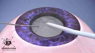 How is cataract surgery performed [upl. by Ibrahim230]