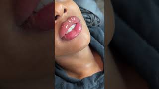 1ml needle less lip fillers touch up using the Hyaluron Pen [upl. by Melone]