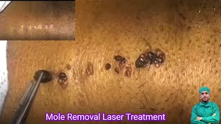 Skin Tags amp Mole Removing By Cautery Machine  Acne Scar amp Mole Permanent Solution  skincare [upl. by Hajar]