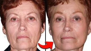 Is CO2 Fractional Laser Resurfacing WORTH IT Plastic Surgeon Answers [upl. by Furlani]