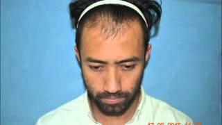 Celebrity Hair Transplant Guwahati 80110028709085887034 [upl. by O'Dell]