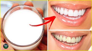 How To Whiten Teeth at Home in 2 Minutes  Teeth Whitening Naturally [upl. by Edniya347]