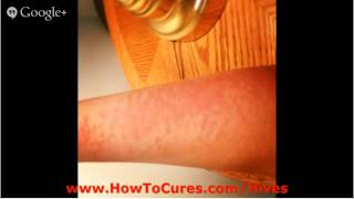 Delayed Pressure Urticaria  Remedies For Allieviating Physical Urticaria  Delayed Pressure Urticar [upl. by Faina]