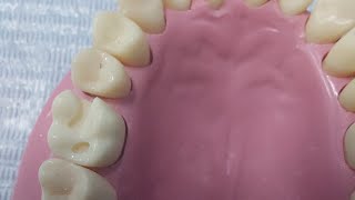 شرح class 2 cavity preparation for amalgam restoration upper 6 Drghazal [upl. by Aidnahs]