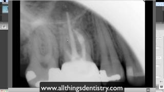 Endodontic Perforation  Hints to help you when it happens to you [upl. by Fevre]