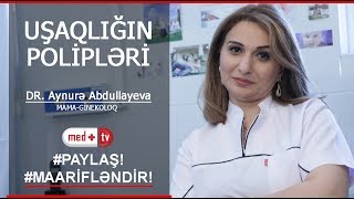 Usaqligin polipleri Uşaqlıq polipi  Ginekoloq Aynura Abdullayeva  Medplus TV [upl. by Esidarap243]