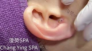 清粉刺推薦耳朵黑頭Blackheads on ear Removal 耳の角栓耳掃除 [upl. by Nomolos]