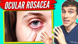 Ocular Rosacea Treatment  7 Tips to Help get Relief [upl. by Rehtae]