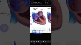 Atrial Fibrillation [upl. by Devine]