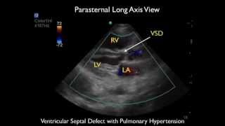 Pulmonary Hypertension Hemoptysis and an Echocardiographic Finding of a Ventricular Septal Defect [upl. by Aleta]