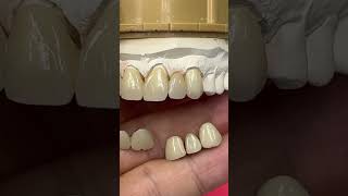 Metal Ceramics vs Monet Pure Zirconia Ceramics [upl. by Sarchet]