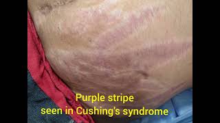 PURPLE STRIAE  CUSHINGS SYNDROME [upl. by Prady]