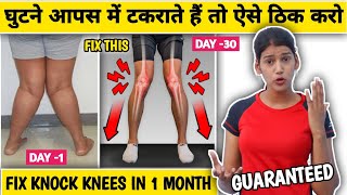 Correct Knock Knees In 1 Month EFFECTIVE Exercises To Fix Knock Knees For Forever [upl. by Shiroma139]