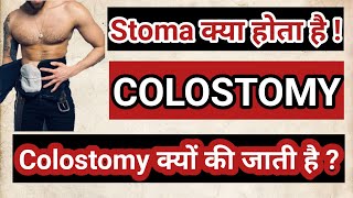 colostomy  colostomy care in hindi  colostomy bag  colostomy care  stoma bag [upl. by Pandich992]