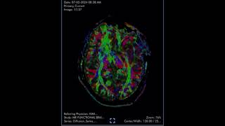 Diffusion tensor imaging DTI is an MRI technique that analyzes the anatomy of nerve cells [upl. by Gillespie791]