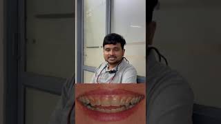 Dental Bleaching quot A Smile changing Procedure quot [upl. by Eelibuj]