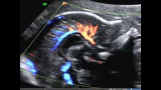 ISUOG How to image the fetal corpus callosum course of the pericallosal artery [upl. by Damarra]