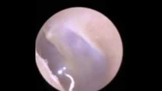 Endoscopic Ear Wax Removal in Leicester by Suction  The Hear Clinic [upl. by Server377]