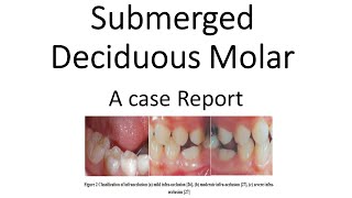 Submerged Deciduous Molars  A Case Report [upl. by Hedva527]