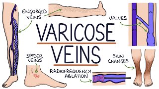 Understanding Varicose Veins [upl. by Kind]