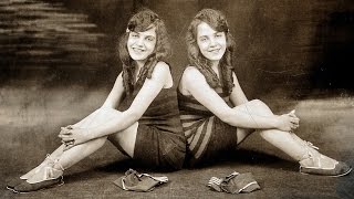 10 Longest Living Conjoined Twins  Pastimers [upl. by Anyk]