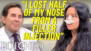 NonSurgical Nose Job Nightmare Melissa Lost Half Her Nose  Botched  E [upl. by Hadias]