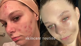 the skincare routine that FINALLY cleared my acne [upl. by Chuah381]