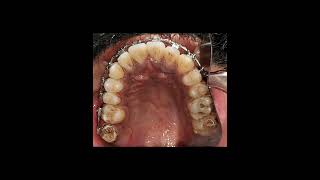 Skeletal Class III Malocclusion treated Orthodontically NonSurgical [upl. by Horten94]