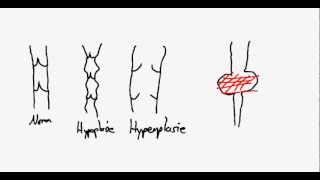 Lymphdrainage Theorie Primäres und Sekudäres Lymphödem [upl. by Enamrej]