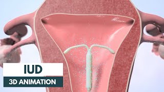 How does an IUD work  3D animation [upl. by Romeon]